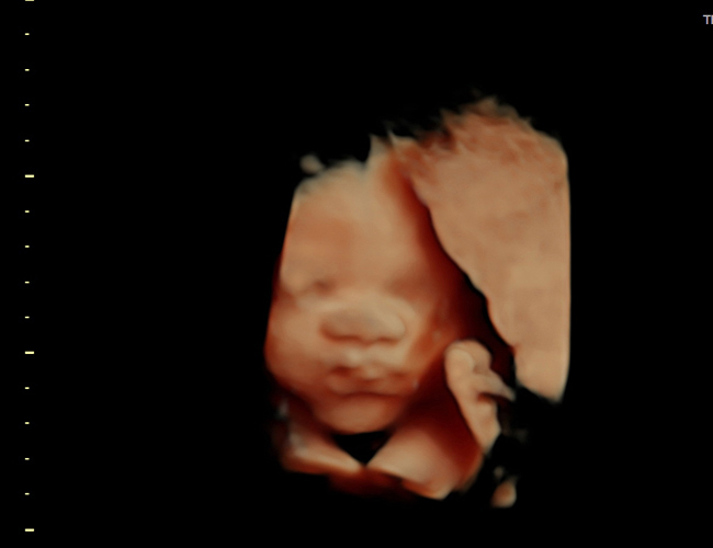 3D ultrasound image at 29 weeks